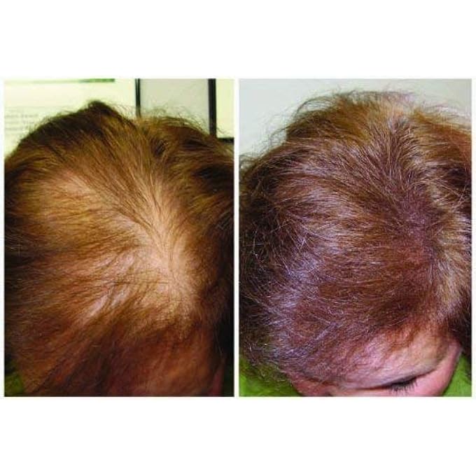 miracle plus UNISEX THICK HAIR SHAMPOO FOR THINNING HAIR 8OZ) - Image 2