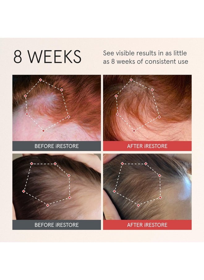 iRestore iRESTORE Scalp Serum | Hair Growth Serum for Women Men | Best for Hair Loss Hair Thinning | Aids Regrowth with Redensyl Capixyl & Biotin | Hydrates Scalp for Visibly Thicker Fuller Hair - 2 Fl Oz  - Image 2
