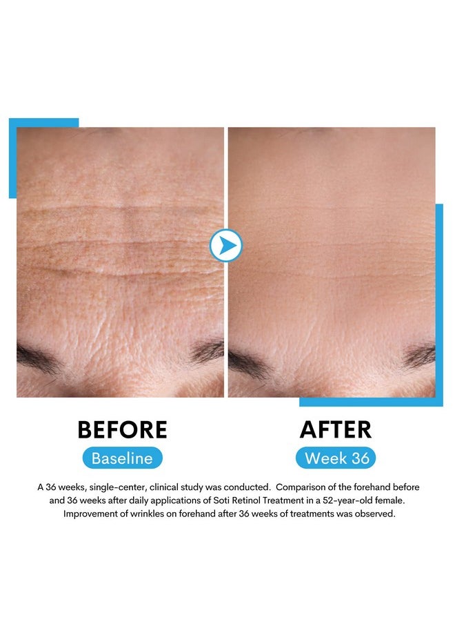 SOTI Soti 2.5% Retinol Serum, Reduces Wrinkles, Age Spots, Post-Acne Marks. Stimulates Collagen, Firm Skin, Anti Aging with Hyaluronic Acid, Niacinamide (30ml)  - Image 2