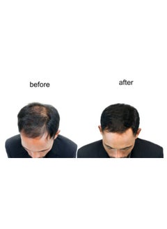Dar Al Dawa Hair grow 5% Minoxidil 50ml With Derma Roller  - Image 3