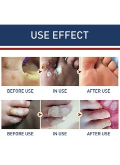 SOUTH MOON 24 Pcs Foot Corn Removal Plaster,Natural Ingredients,Foot Care Expert,Calluses Plantar Treatment,Relief Pain From Calluses, Corns, Blisters, Heel Frictions  - Image 5