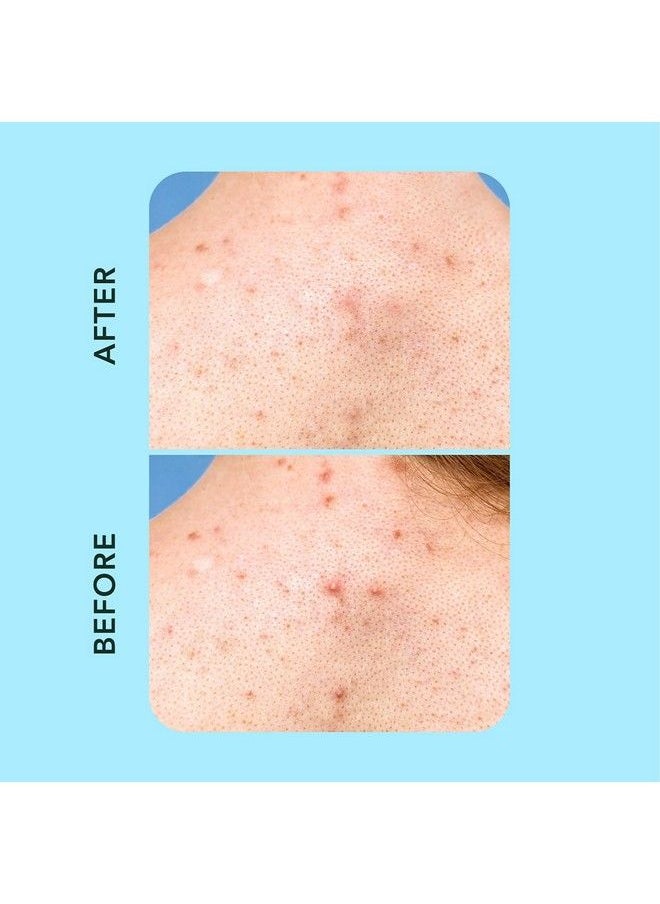 Rael - Pimple Patches Miracle Xl Spot Control Cover Hydrocolloid Acne Patches For Face Zit And Blemish Spot Back And Body For All Skin Types Vegan Cruelty Free (6 Count) - Image 1