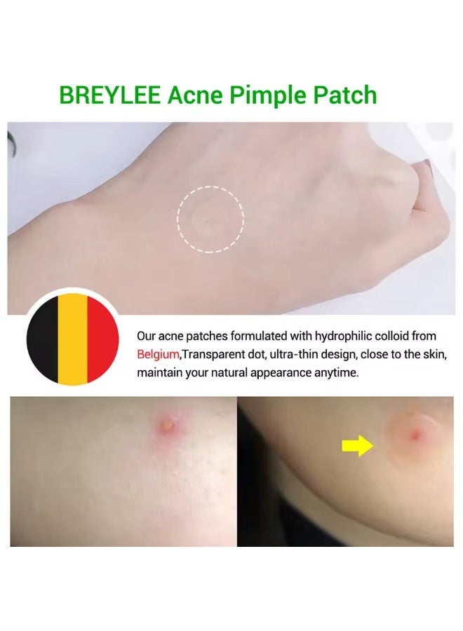 Breylee Facial  Acne and Pimple Removal Tools, Self-adhesive Blackhead Type - Image 5