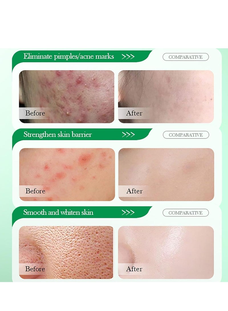 فيني جل علاج حب الشباب من شجرة الشاي ، علاج البقع للوجه ، جل مضاد لحب الشباب للبثور ، مزيل البقع الداكنة للوجه ، ترطيب للعناية بالبشرة تتلاشى بقع حب الشباب التحكم في الزيت يتقلص المسام 20 جرام - Image 4