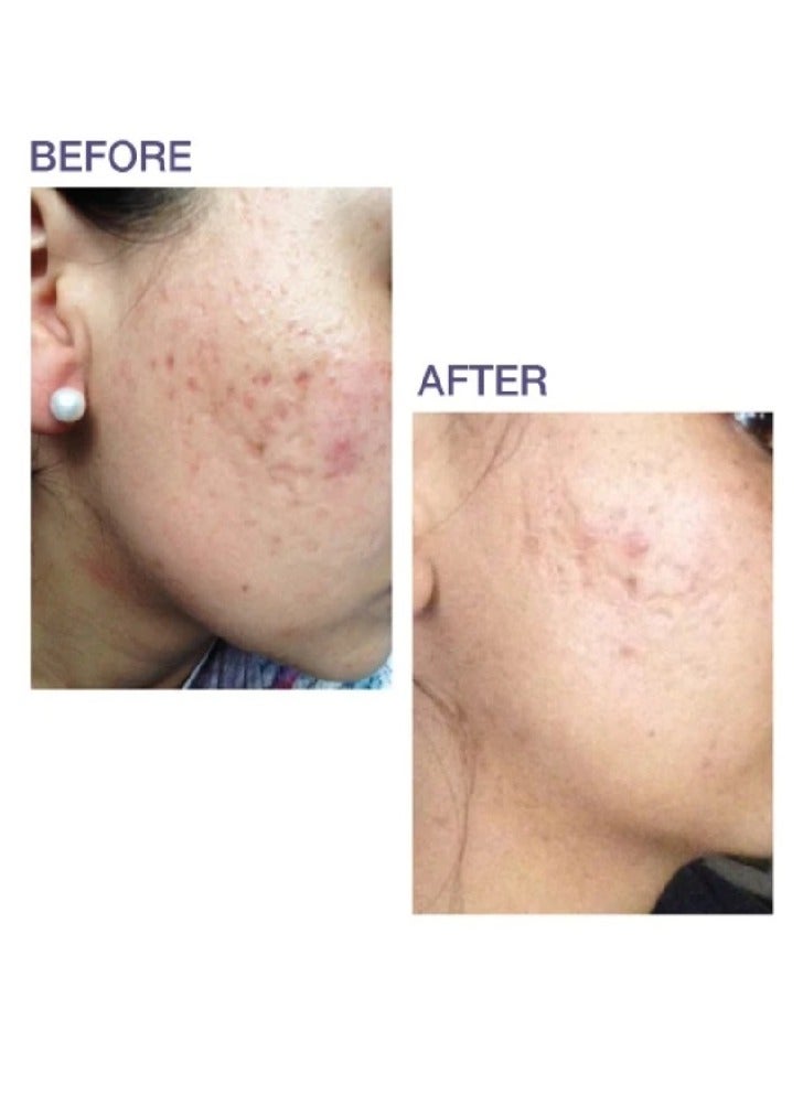 PROSIL Prosil SPF 15 Silicone Stick For Scars  - Image 2