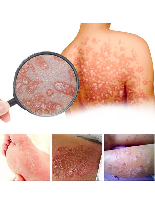 SOL LORA - Bee Venom Psoriasis Cream, New Zealand Bee Venom Professional Psoriasis Cream For Itchy Skin Fast Relief Cream For Face And Body, Soothing And Moisturizing Psoriasis Cream 20G - Image 1