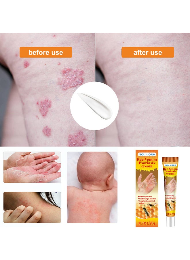 SOL LORA - Bee Venom Psoriasis Cream, New Zealand Bee Venom Professional Psoriasis Cream For Itchy Skin Fast Relief Cream For Face And Body, Soothing And Moisturizing Psoriasis Cream 20G - Image 1