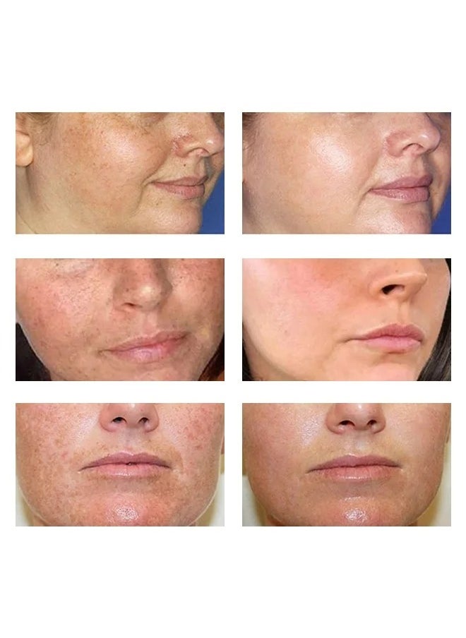 iBealee Dark Spot Remover for Face Peeling Skin Whitening Freckle Cream Pigmentation Treatment Sun Spots Age Spots Blemish Remover Lightening Cream  - Image 2