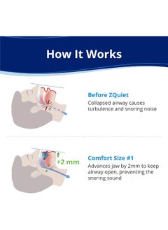 ZQuiet ZQuiet, Anti-Snoring Mouthpiece, Comfort Size #1, Single Refill, Blue, Made in USA, BPA-Free, Medical-Grade Material  - Image 2