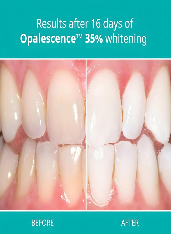 Opalescence 35% Gel Syringes Teeth Whitening - Refill Kit (2 Pack / 4 Syringes Total) Carbamide Peroxide. Made by Ultradent, in Melon Flavor. Tooth Whitening Refill Syringes 5404-1 - Image 3