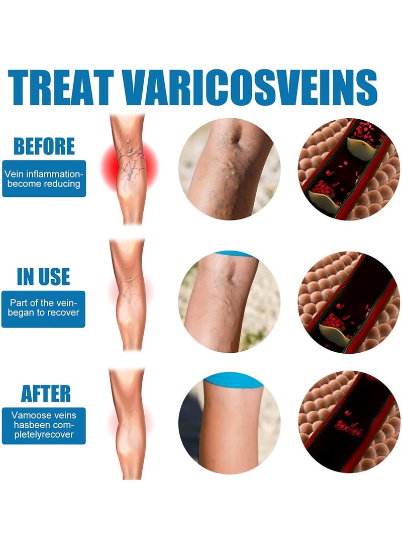 SOUTH MOON Veinhealing Varicose Vein Treatment Spray, Varicose Vein Treatment Legs, Varicose Vein Miracle Spray, Improve Circulation, 30ml - Image 4