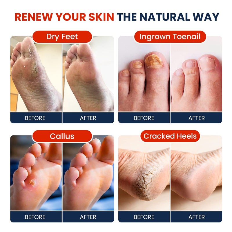 Foot Cure علاج القدم - نقع القدم مع أملاح إبسوم - مزيج طبيعي بالكامل للعناية بالقدمين للاسترخاء - يلين الكالو ويجدد القدمين - رائحة منعشة، باديكير سبا - 16 أونصة (عبوة من 1) - Image 4