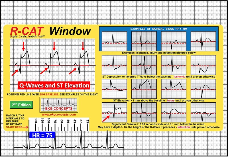 R-Cat نافذة R-CAT EKG الطبعة الثانية - Image 3