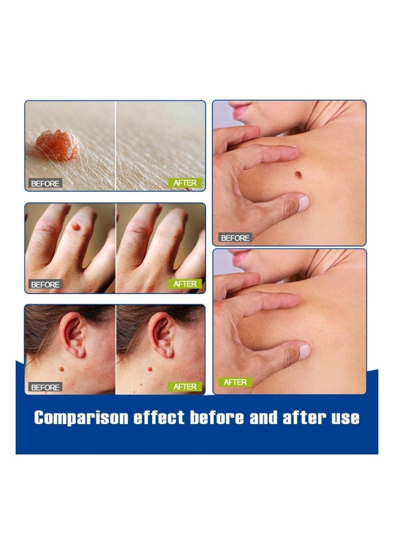 ERAYCEE Tags & Moles Remover Pen For Face Body, Mole Remover Fast Easy Effective Easy To Remove Tags, Moles, Warts 1Pc 4 ml  - Image 5