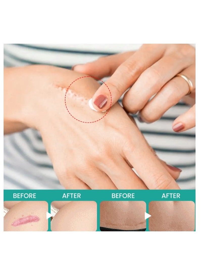 سوميفون كريم العناية بالندبات كريم إزالة الندبات للبشرة التالفة والجلد الميت متعدد الأغراض للجنسين 20 جم - Image 3