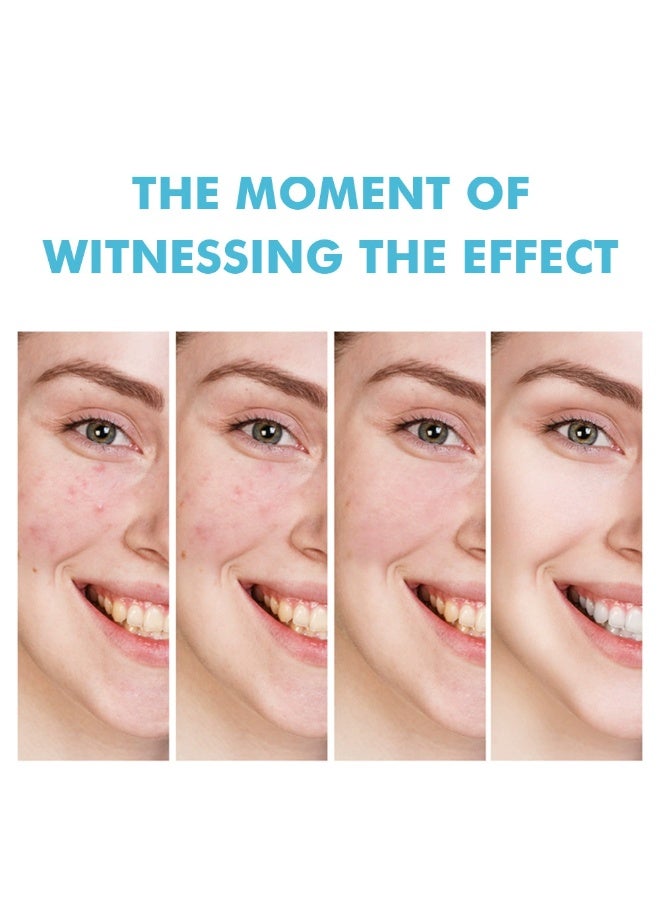MOOYAM Salicylic Acid Remove Acne Treatment Gel 20g Rapid Action Acne Spot Treatment for Face Lightens Acne Marks Removes Acne and Shrinks Pores Fast Acne Removal for Face to Control and Clear Breakouts - Image 4