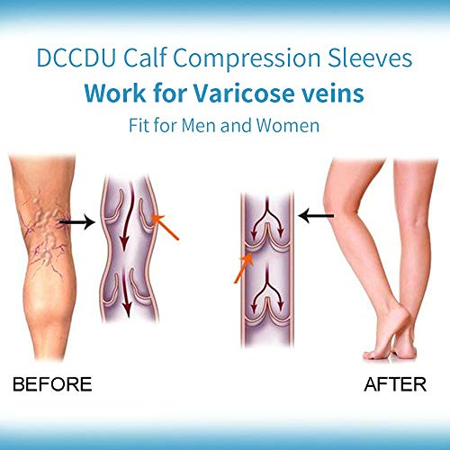 IRIS Medical Knee High Open Toe Compression Stockings(Women&Men) Firm Support 20-30mmHg,Graduated Toeless Knee Support Stockings Hose for Swelling,Varicose Veins,Lymphedema(1 pc) - Image 4