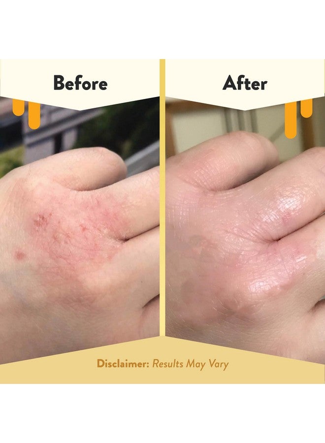 ECZEMA HONEY Nut-Free Original Skin-Soothing Cream - Honey Lotion For Dry & Sensitive Skin - Natural Eczema Cream For Adults & Kids - Itchy Relief Cream For Eczema, Psoriasis, Dermatitis & More (4 Oz) - Image 4