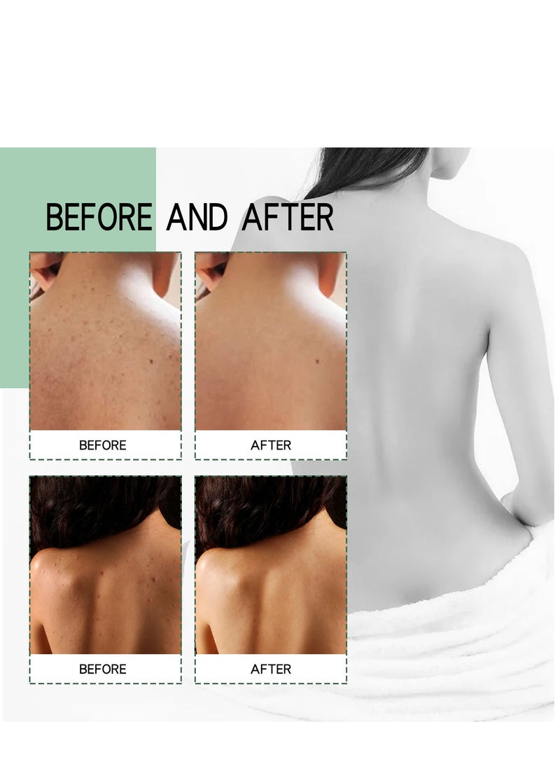 إيلهو رذاذ للجسم، علاج لحب الشباب على الظهر، رذاذ مقشر لحب الشباب للظهر والجسم، بشرة ناعمة، ترطيب للظهر، علاج لحب الشباب للظهر، الرؤوس السوداء والبقع 120 مل - Image 5