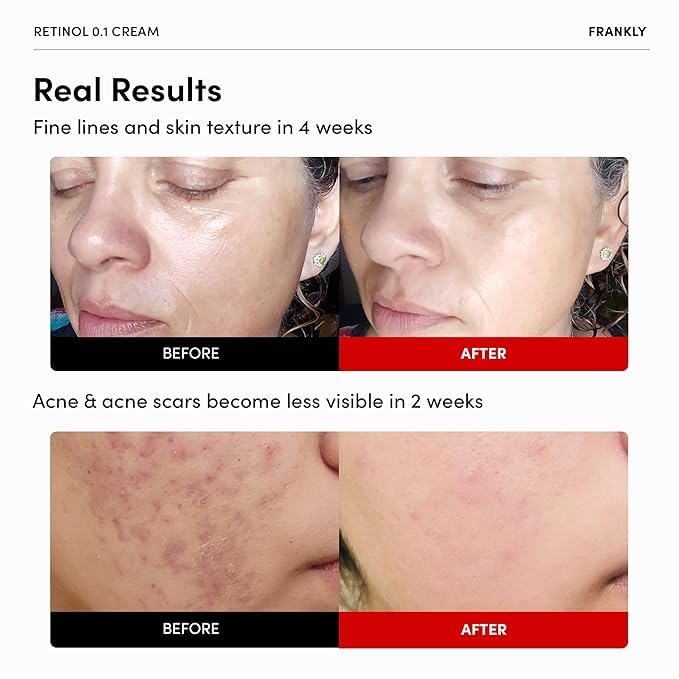 FRANKLY Retinol 0.1% Cream, 1.01 fl oz - Beginner Retinol | Night Cream | with Ceramides & Natural Ginseng | Anti-aging, Wrinkles Care, Reduces Congestion and hyperpigmentation | Korean Skin Care - Image 2