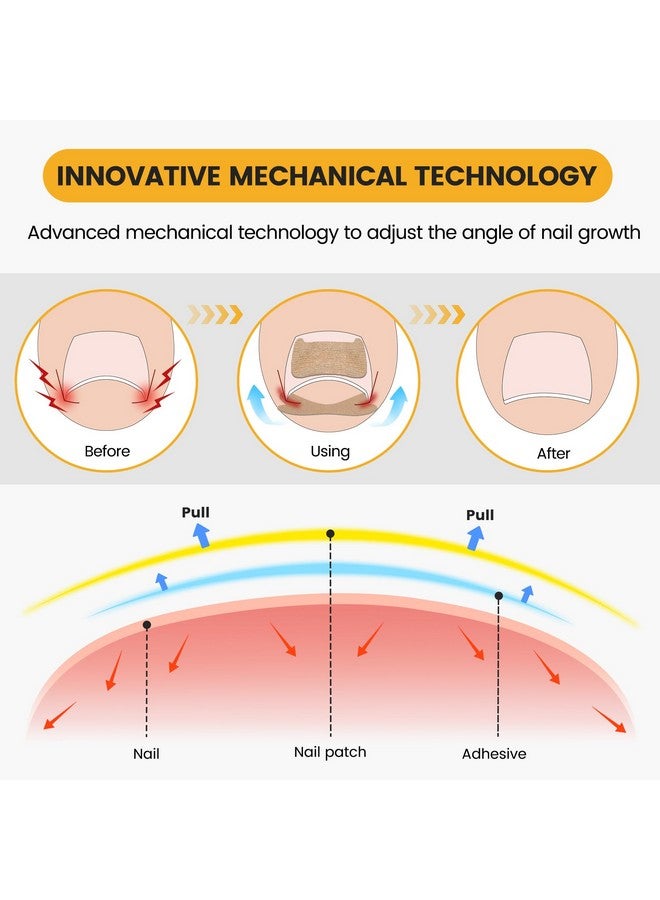 BEZOX 60Pcs Breathable Ingrown Toenail Corrector Patches And 50Pcs Ingrown Toenail Stickers - Professional Ingrown Toe Nail Treatment Tape For Pain Relief And Correction - Image 3