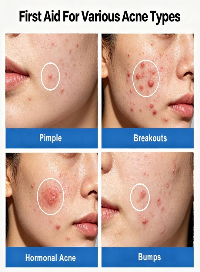AOAO Salicylic Acid Acne Serum, Acne Drying Lotion for Acne-Prone Sensitive Skin, Shrinks Pimples Overnight, Fade Acne Marks, 20% Zinc Oxide Medicated Spot Treatment for Pimples and Blemishes, 0.34 fl oz - Image 2