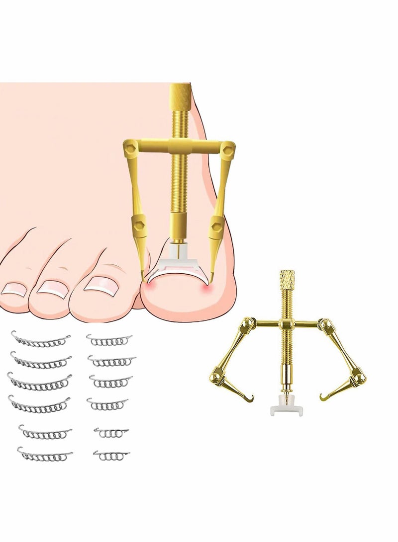 SYOSI Ingrown Toenail Treatment Kit with 12 Toenail Braces, Pure Copper Ingrown Toenail Lifter, Steel Foot Care Tool for Paronychia - Image 1