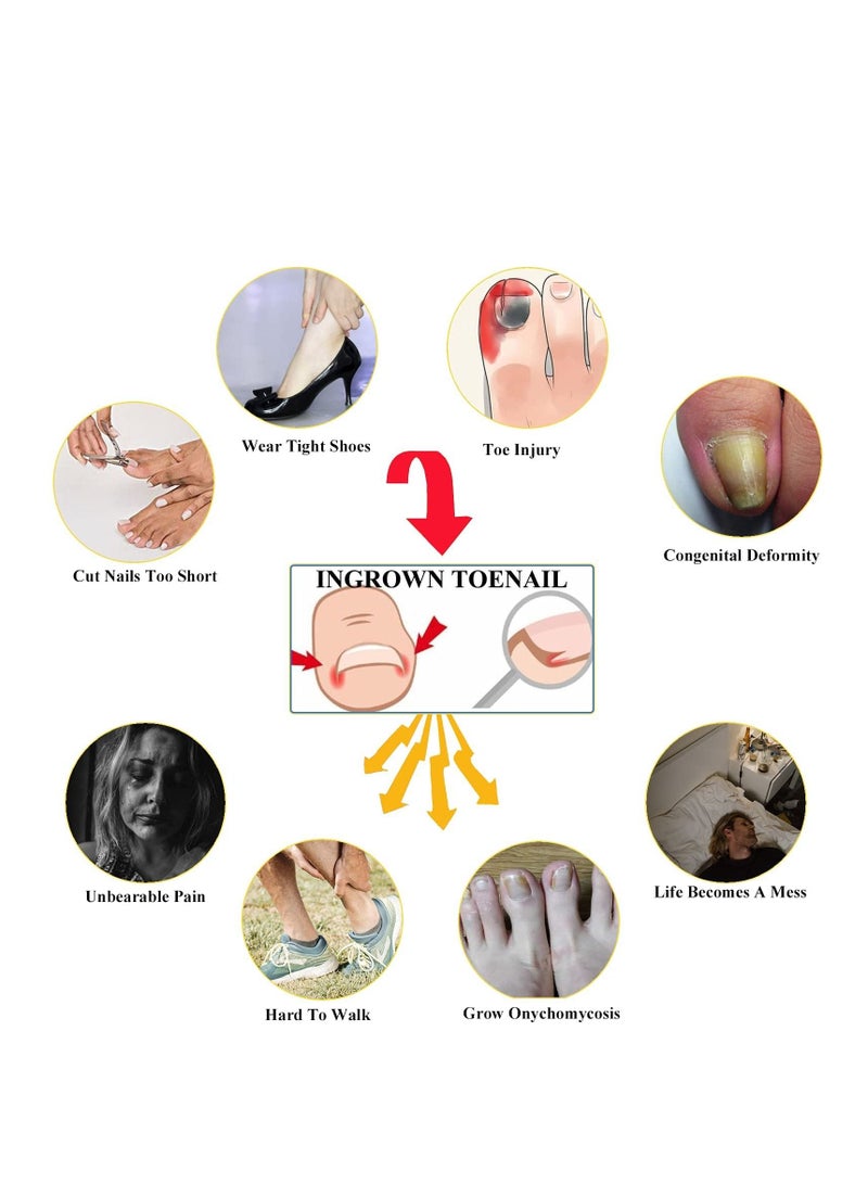 SYOSI Ingrown Toenail Treatment Kit with 12 Toenail Braces, Pure Copper Ingrown Toenail Lifter, Steel Foot Care Tool for Paronychia - Image 4