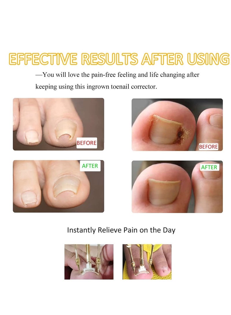 SYOSI Ingrown Toenail Treatment Kit with 12 Toenail Braces, Pure Copper Ingrown Toenail Lifter, Steel Foot Care Tool for Paronychia - Image 5