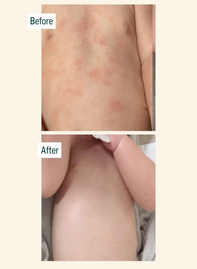 Oleum Cottage Rashes & Eczema Oil for Kids (100ml) | Diaper Rash Massage Oil for Babies | Relief from Cradle Cap, Itchiness, Inflammation, Redness & Skin Irritation | Non-Greasy | 100% Safe & Natural - Image 5