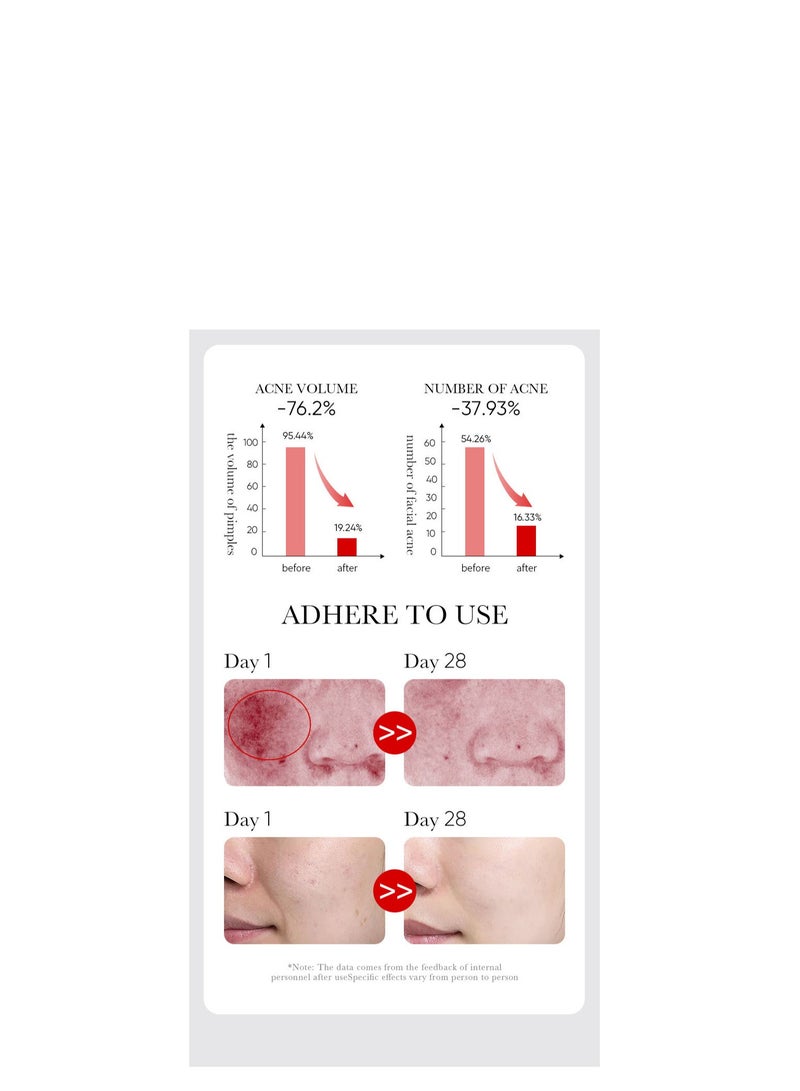سادور AHA BHA حمض الفواكه لإزالة حب الشباب الطباعة ترطيب حب الشباب إزالة جوهر 30ML - Image 5
