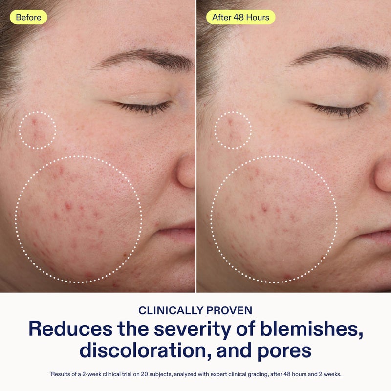 Skinfix 2% BHA Cleanser - 5 oz - Clears Acne Blemishes & Blackheads - Safe for All Types of Acne - Fragrance Free - Vegan, Cruelty Free - Image 3