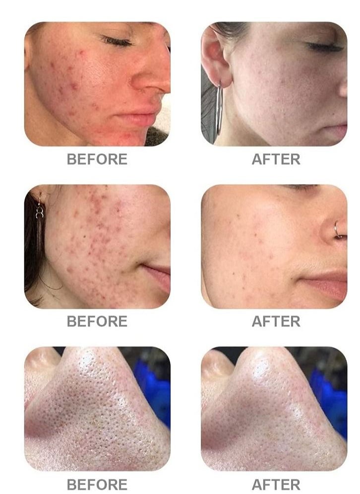 Beauty Palm - AS1 SA2 AO3 Aqua Peeling Solution Hydrafacial Solution Premium - Image 1