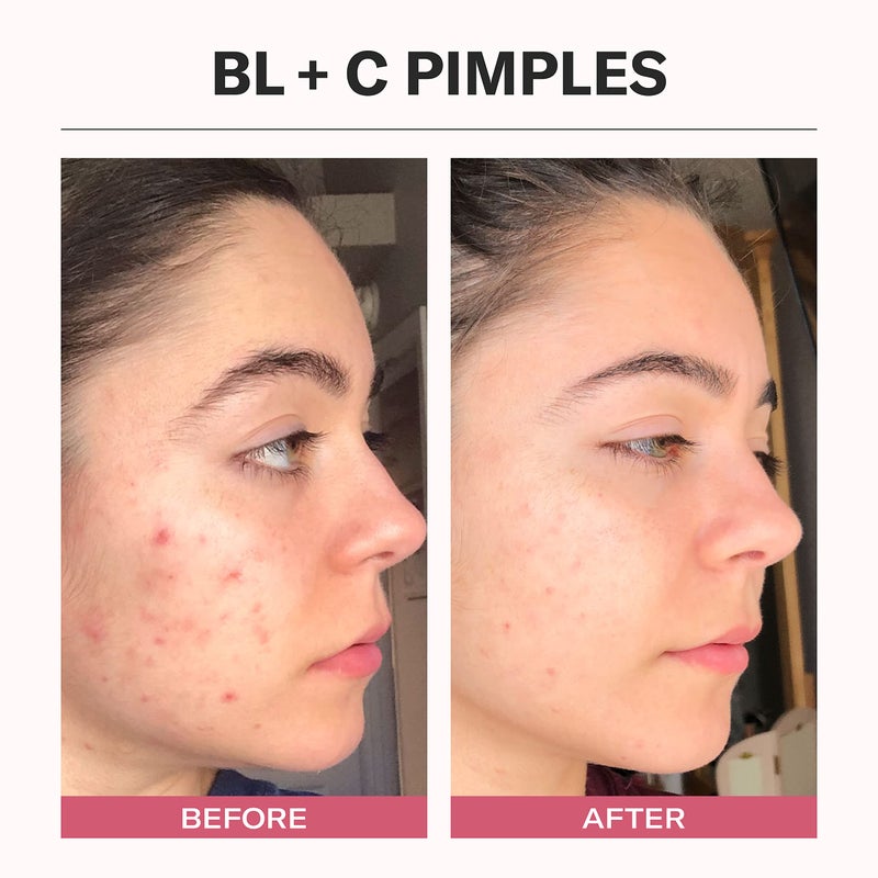 Odacite سيروم أوداسيت لعلاج حب الشباب للوجه، زيت تنظيف المسام للوجه للبثور مع الكمون الأسود + الكاجبوت - سيروم وجه مPurifying مع فيتامين A ومكونات طبيعية - 0.17 أونصة سائلة - Image 5