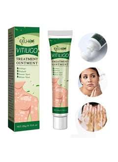 EELHOE Vitiligo Treatment Ointment，For Psoriasis And Skin Vitiligo ...