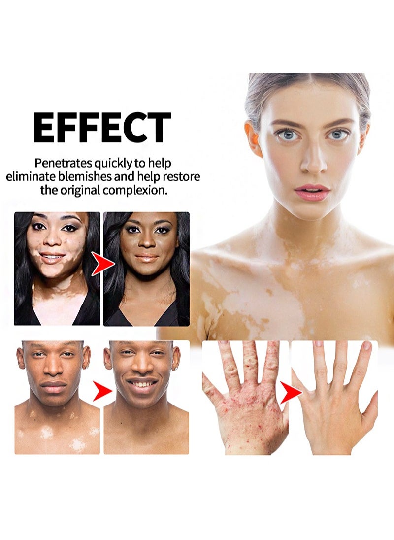 Vitiligo Treatment Ointment，For Psoriasis And Skin Vitiligo, Improve Skin Pigmentation, Reduce White Spots, Vitiligo Care
