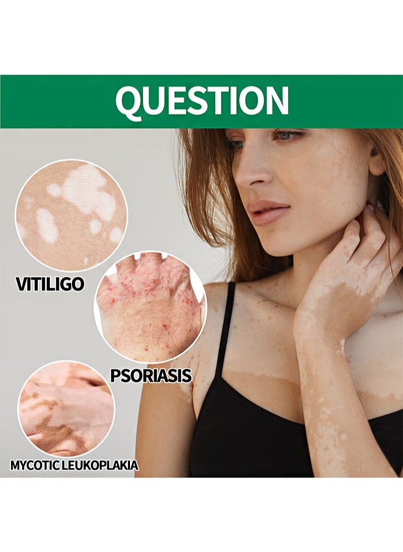 Vitiligo Treatment Ointment，For Psoriasis And Skin Vitiligo, Improve Skin Pigmentation, Reduce White Spots, Vitiligo Care