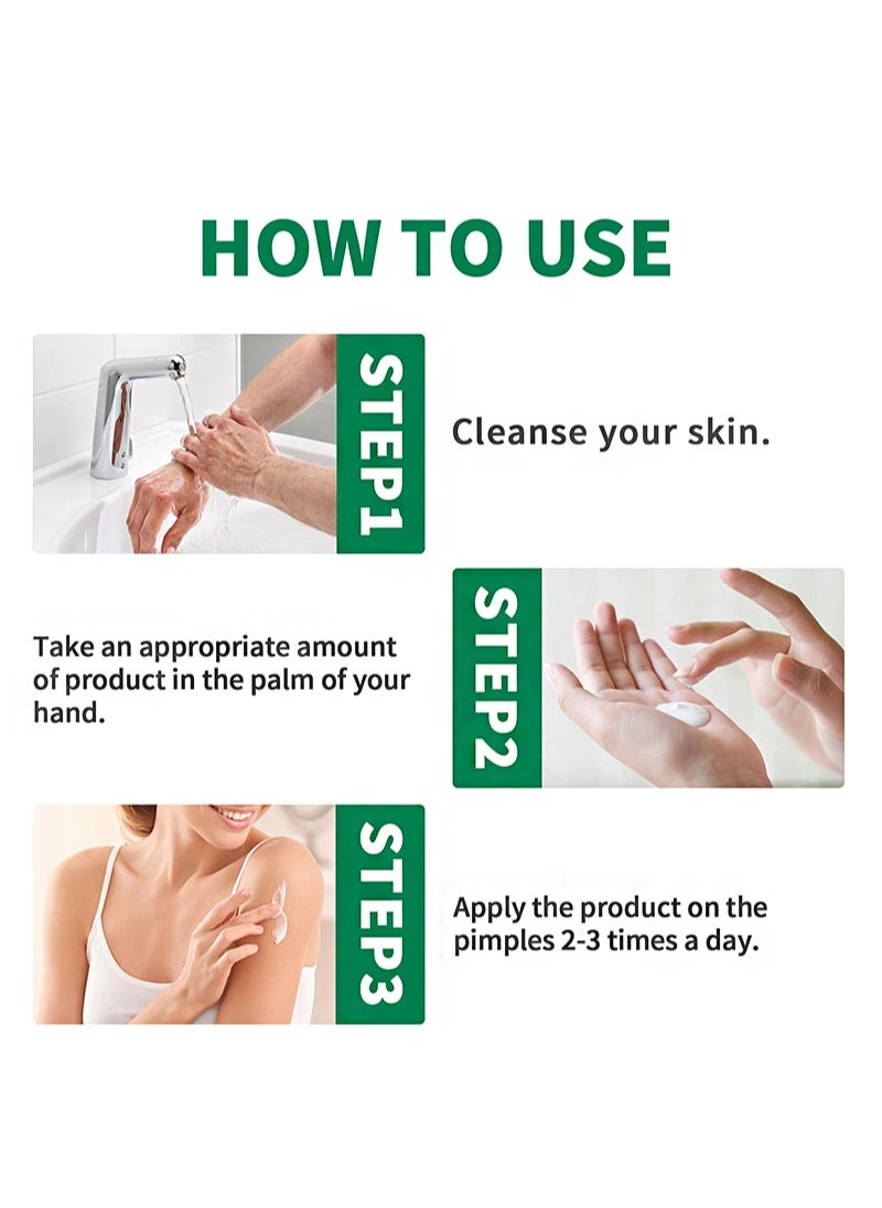 Vitiligo Treatment Ointment，For Psoriasis And Skin Vitiligo, Improve Skin Pigmentation, Reduce White Spots, Vitiligo Care