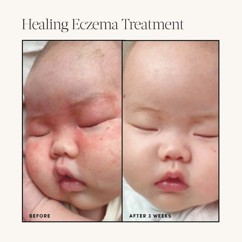Evereden Healing Eczema Treatment, 1.7 fl oz | Eczema Cream | Clean and Fragrance Free Eczema Cream for Babies, Kids, and Adults - Image 5
