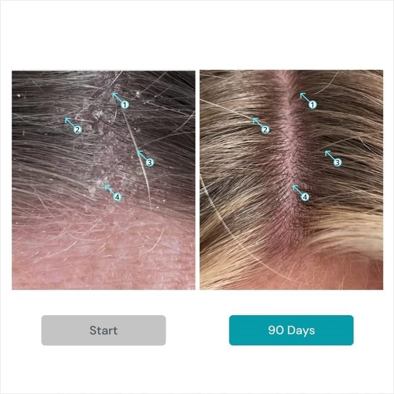 DS LABORATORIES DS Labs Dandrene Dandruff Shampoo & Conditioner Kit, 205mL- for Itchy, Flaky Scalp, Exfoliating Shampoo, Moisturizing Conditioner, Supports Scalp Health & Oil Control - Image 3