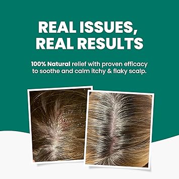 Grahams Natural زيت جراهامز الطبيعي لتخفيف فروة الرأس لفروة الرأس الجافة والحكة والقشور والصدفية والتهاب الجلد الدهني وعلاج قشرة الرأس مرطب ومغذي ومقشر 1 × 100 مل - Image 3