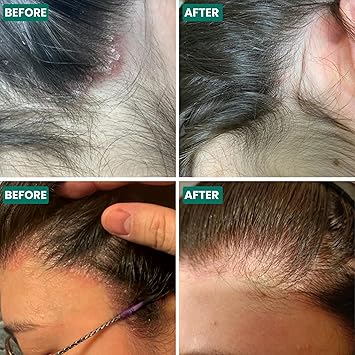 Grahams Natural زيت جراهامز الطبيعي لتخفيف فروة الرأس لفروة الرأس الجافة والحكة والقشور والصدفية والتهاب الجلد الدهني وعلاج قشرة الرأس مرطب ومغذي ومقشر 1 × 100 مل - Image 4