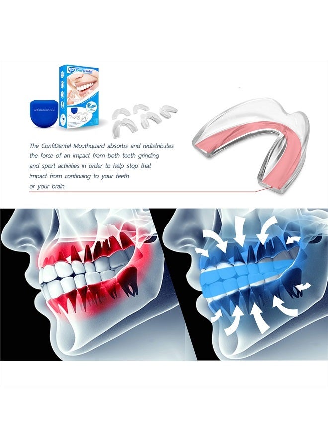 The ConfiDental عبوة من 5 واقيات فم قابلة للتشكيل لطحن الأسنان والضغط عليها (بروكسيسم)، رياضة، صينية تبييض، تشمل 3 واقيات عادية و2 واقيات ثقيلة (3 (lll) عادية 2 (II) ثقيلة) - Image 5
