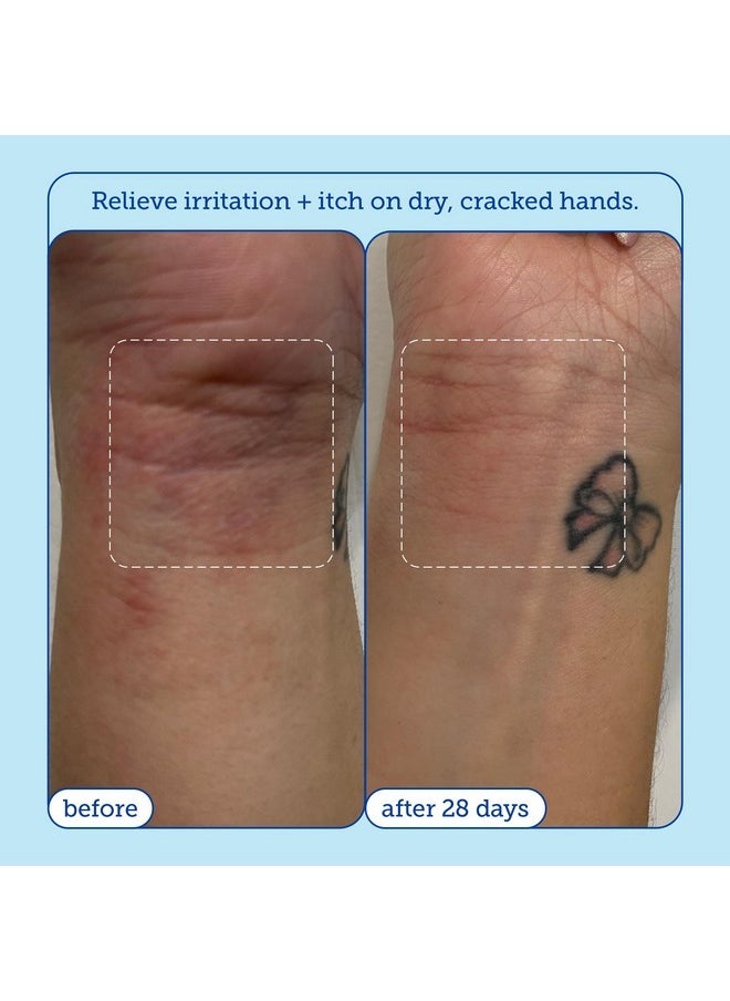 Skinfix - Eczema+ Hand Relief Cream: Hydrating Hand Repair Cream To Address Eczema & Dry, Cracked, Sensitive Skin, 3 Fl Oz - Image 1