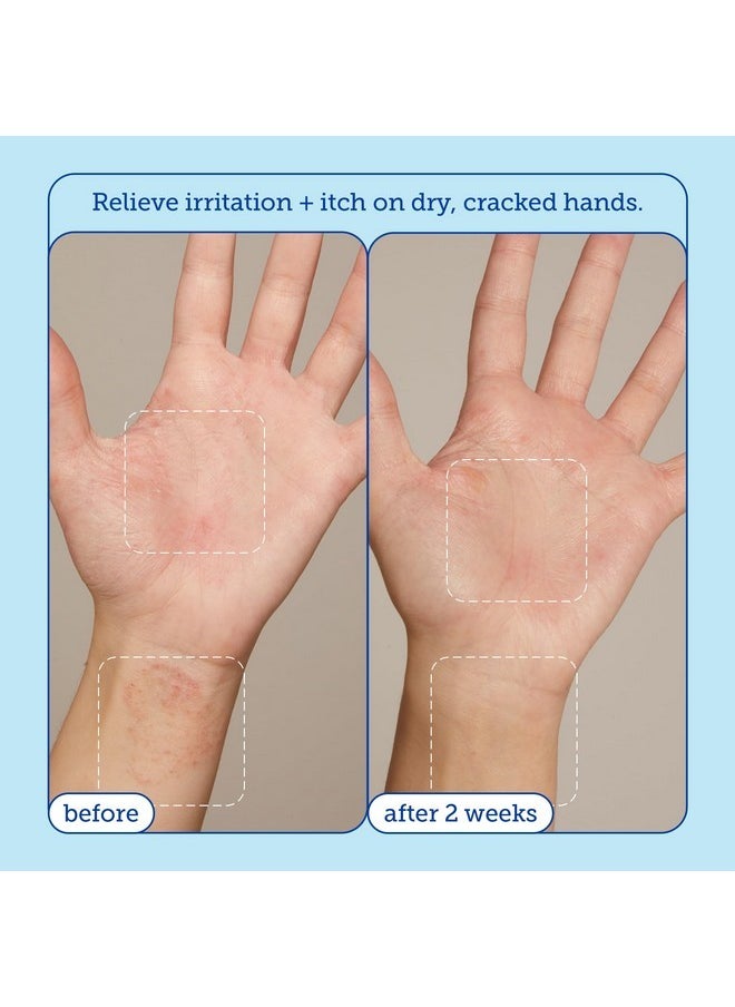 Skinfix - Eczema+ Hand Relief Cream: Hydrating Hand Repair Cream To Address Eczema & Dry, Cracked, Sensitive Skin, 3 Fl Oz - Image 1