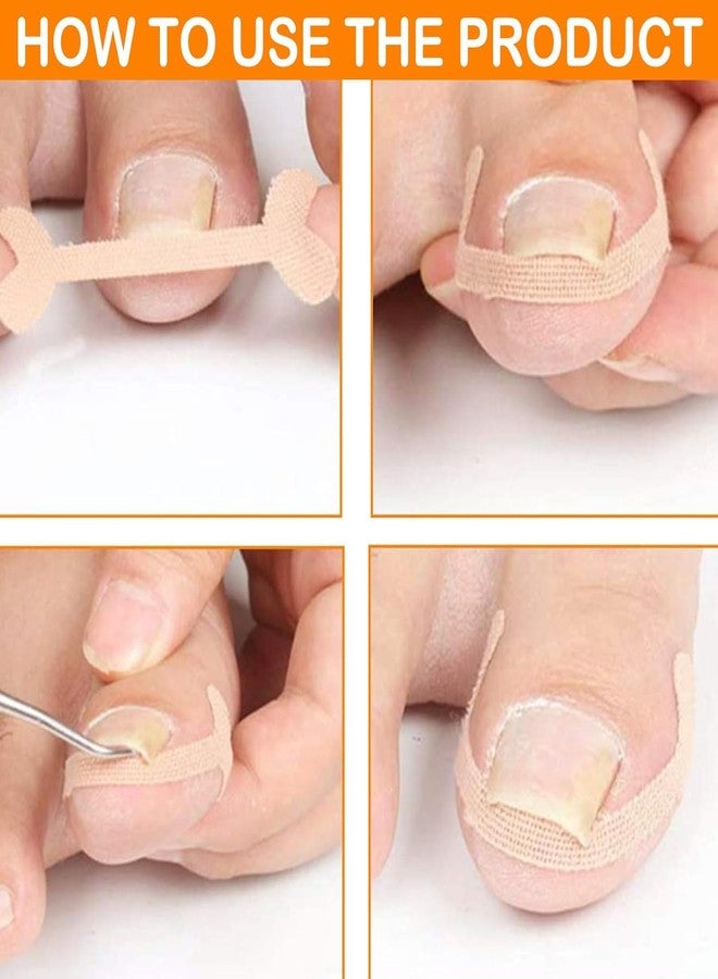 Rexez Pack of 10 Toenail Correction Patches, Ingrown Toenails, Nail Correction Clip, Patch Toenail, Toenail Plaster for Treating Ingrown Toenail - Image 5