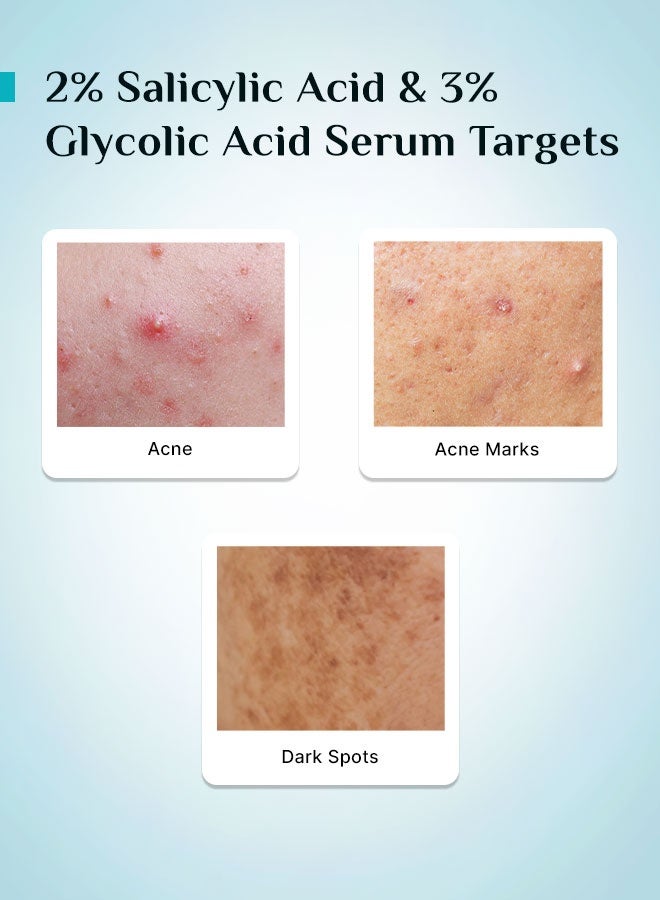 PILGRIM Korean 2% Salicylic Acid + 3% Glycolic Acid Anti Acne Serum for oily & acne prone skin | All Skin Types | Korean Skin Care | For Men & Women | 30ml - Image 5