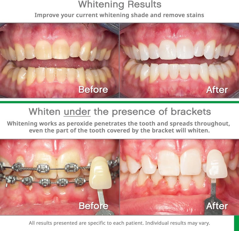 Opalescence Whitening Bundle Opalescence Go 15 Hydrogen Peroxide Prefilled Whitening Trays and Whitening Toothpaste Mint Flavor 51945166 - Image 3