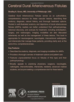 Cerebral Dural Arteriovenous Fistulas  - Image 2