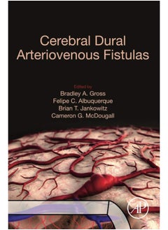 Cerebral Dural Arteriovenous Fistulas  - Image 1